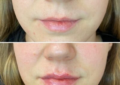 Before & after Image of face in Northborough, MA