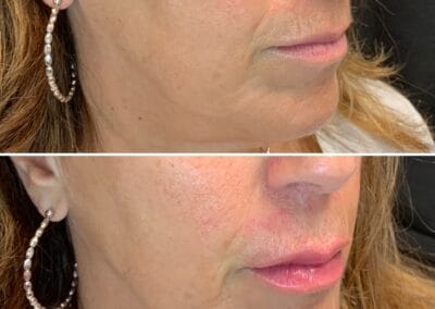 Before & after Image of face in Northborough, MA