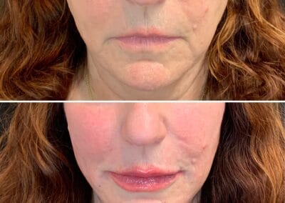 Before & after Image of face in Northborough, MA