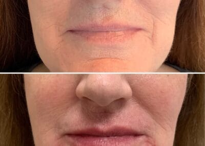 Before & after Image of face in Northborough, MA
