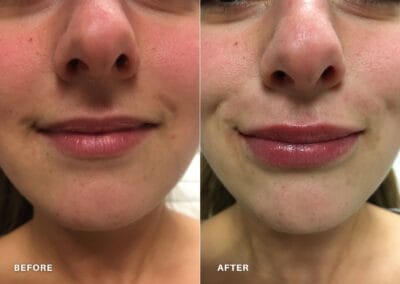 Before & after Image of face in Northborough, MA