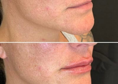 Before & after Image of face in Northborough, MA