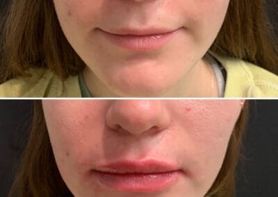 Before & after Image of face in Northborough, MA