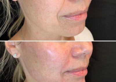 Before & after Image of face in Northborough, MA