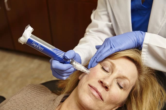 microneedling in Northborough, MA