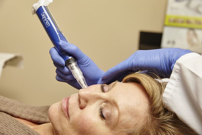 Microneedling with Skinpan in Northborough, MA | RenovoMD