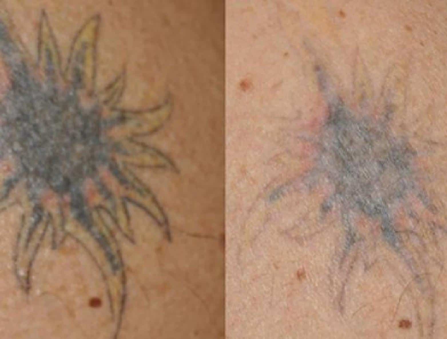 Tattoo-removal Treatment before after | RenovoMD in Northborough, MA