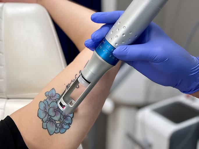 tattoo removal in Northborough, MA