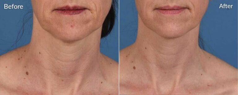 Skinpen Microneedling Before And After in Northborough, MA | RenovoMD