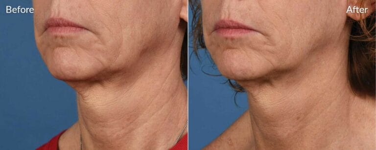 Skinpen-Microneedling-before-and-afterr in Northborough, MA