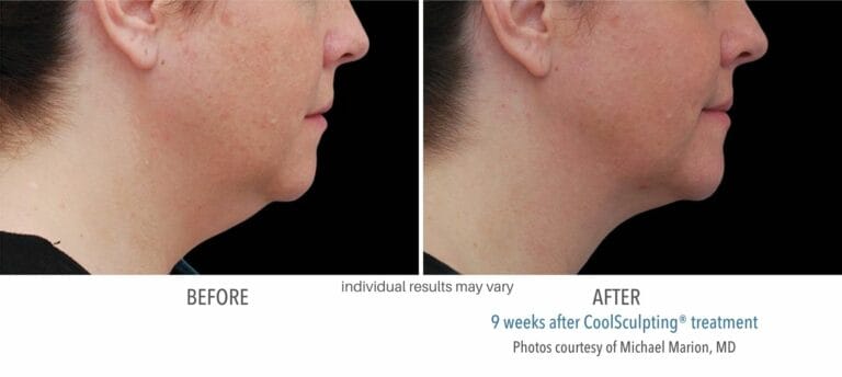 Coolsculpting Before And After in Northborough, MA | RenovoMD
