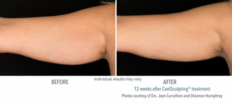 Coolsculpting Before And After ARM | RenovoMD in Northborough, MA
