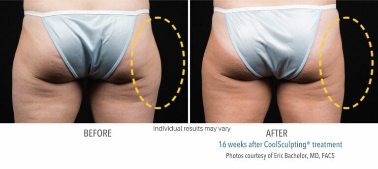 Coolsculpting Before And After Back | RenovoMD in Northborough, MA