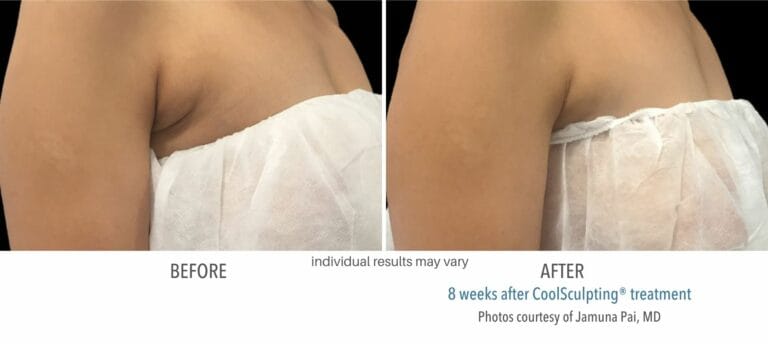 Coolsculpting Before And After Body | RenovoMD in Northborough, MA