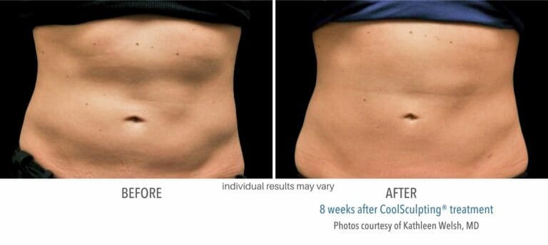 Coolsculpting Before And After Stomach in Northborough, MA | RenovoMD