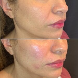 dermal Fillers | Best Medical Spa in Northborough, MA