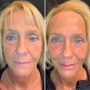 Dermal Fillers Gallery | Best Medical Spa in Northborough, MA