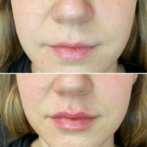Dermal Fillers Before And After Gallery | Best Medical Spa in Northborough, MA