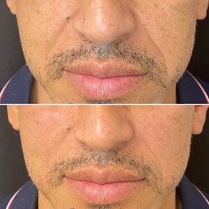 Dermal Fillers Images | Best Medical Spa in Northborough, MA