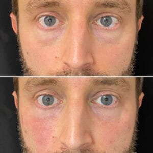 Dermal Fillers Before And After Gallery 2 | Best Medical Spa in Northborough, MA