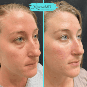 Dermal Fillers Images 2 | Best Medical Spa in Northborough, MA