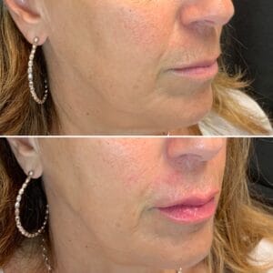 Dermal Fillers Before And After in Northborough, MA | Best Medical Spa in Northborough, MA