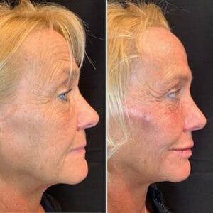 Dermal Fillers in Northborough, MA | Best Medical Spa in Northborough, MA