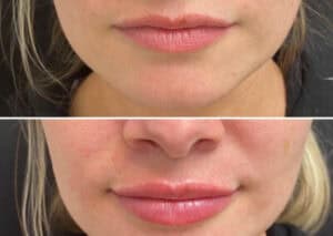 Dermal Fillers Before And After Images | Best Medical Spa in Northborough, MA