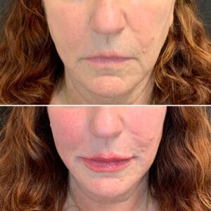 dermal-fillers in Northborough, MA
