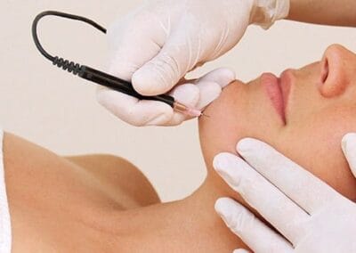 Electrolysis Laser Hair Removal in Northborough MA | Best Medical Spa in Northborough, MA