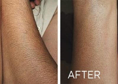 Renovo Laser Hair Removal Before And After Hand | Best Medical Spa in Northborough, MA