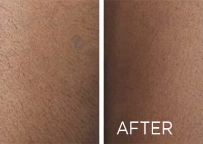 Renovo Laser Hair Removal Before And After Leg | Best Medical Spa in Northborough, MA