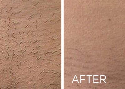Renovo Laser Hair Removal in Northborough MA | Best Medical Spa in Northborough, MA