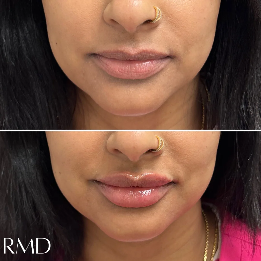 a woman's face with a comparison of her lips after dermal filler in Northborough, MA