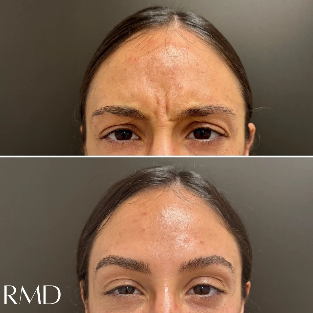 A comparison of a woman's face comparing her skin and after in Northborough, MA