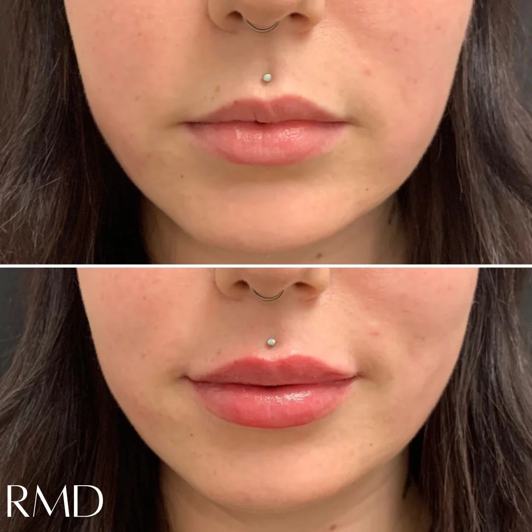 a woman before and after getting dermal fillers in Northborough, MA