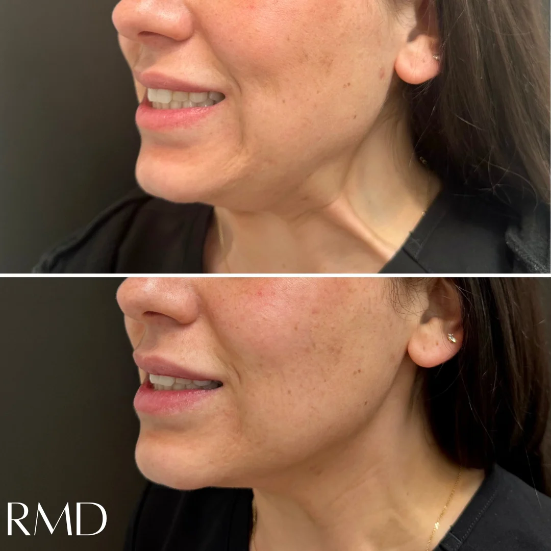 a woman with a neck and chin in Northborough, MA