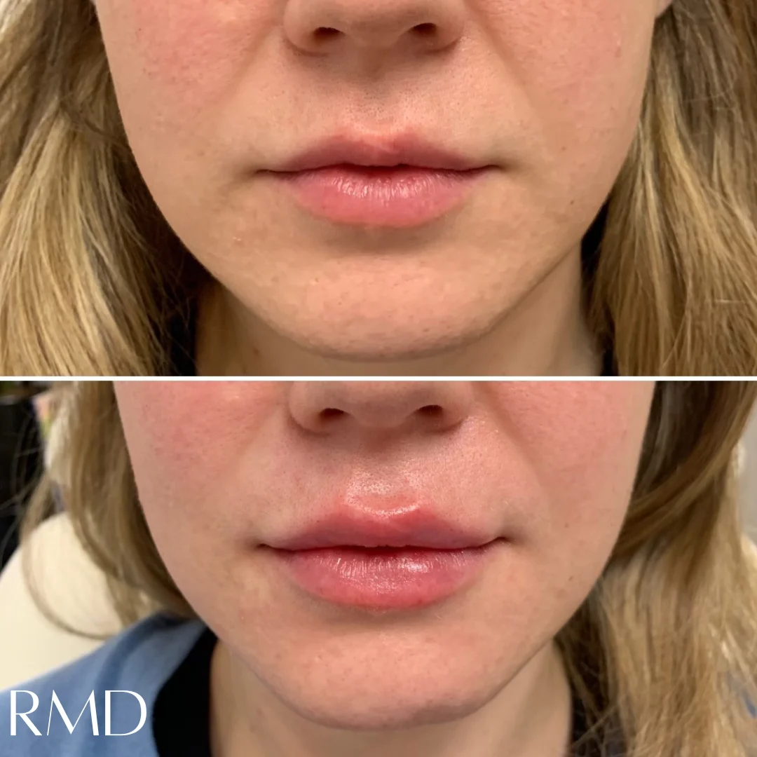 a woman's face with a comparison of the same lip in Northborough, MA