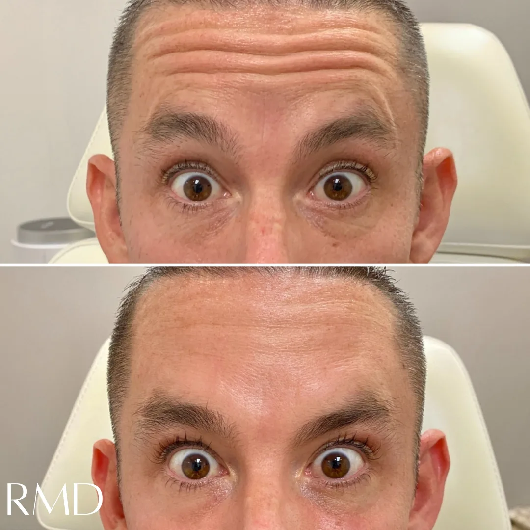 a man with wide eyes, comparing before & after in Northborough, MA
