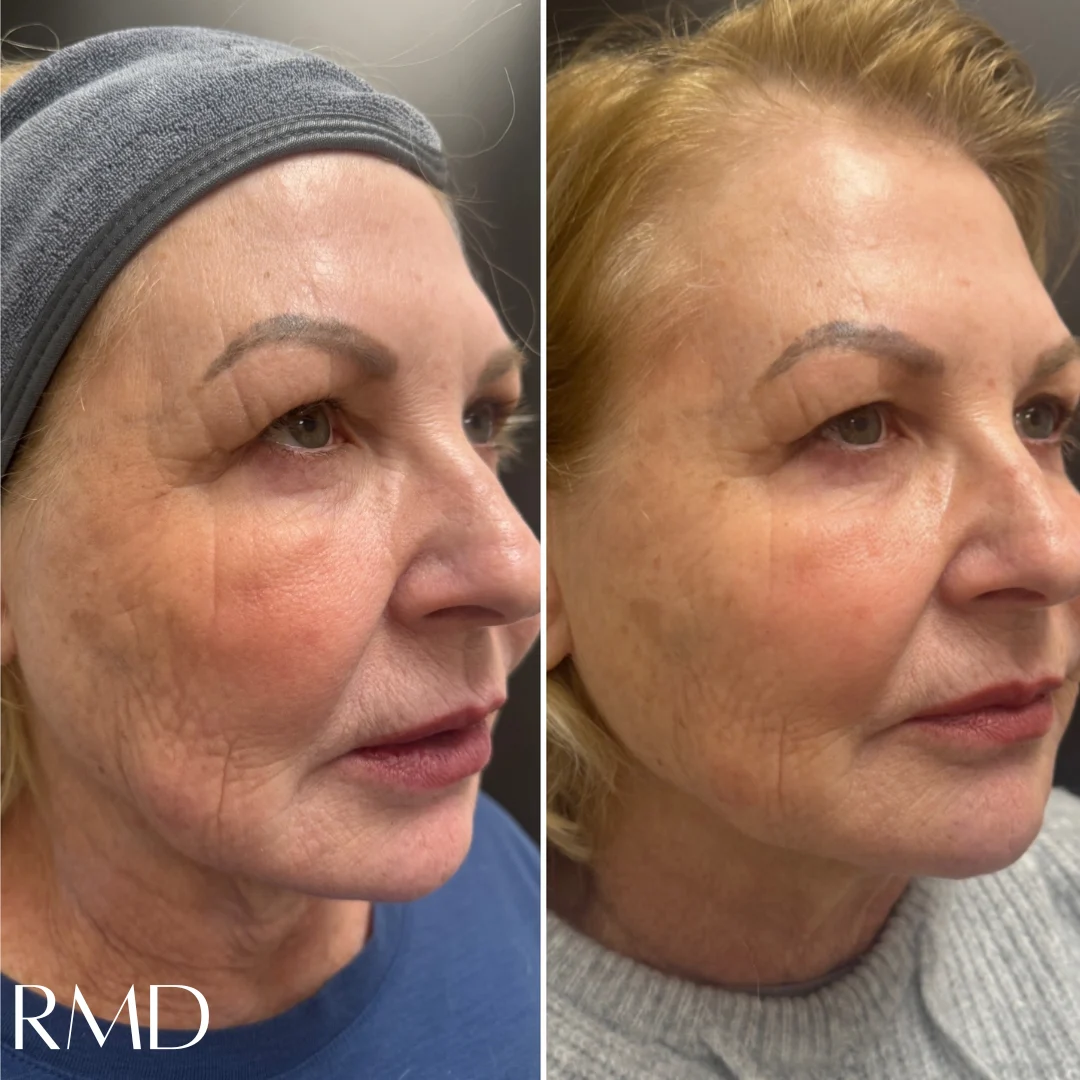 a woman with wrinkles on her face in Northborough, MA
