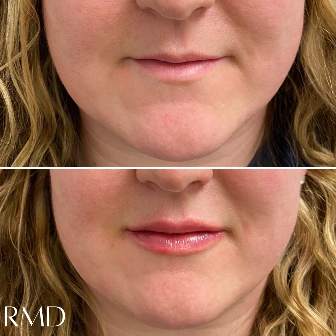 a woman's face with a comparison of her lips after dermal filler in Northborough, MA