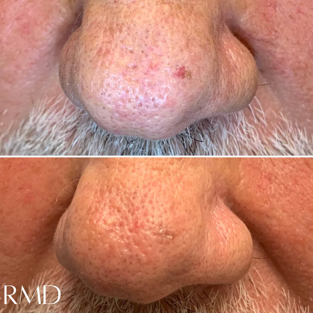 close up of a person's nose in Northborough, MA
