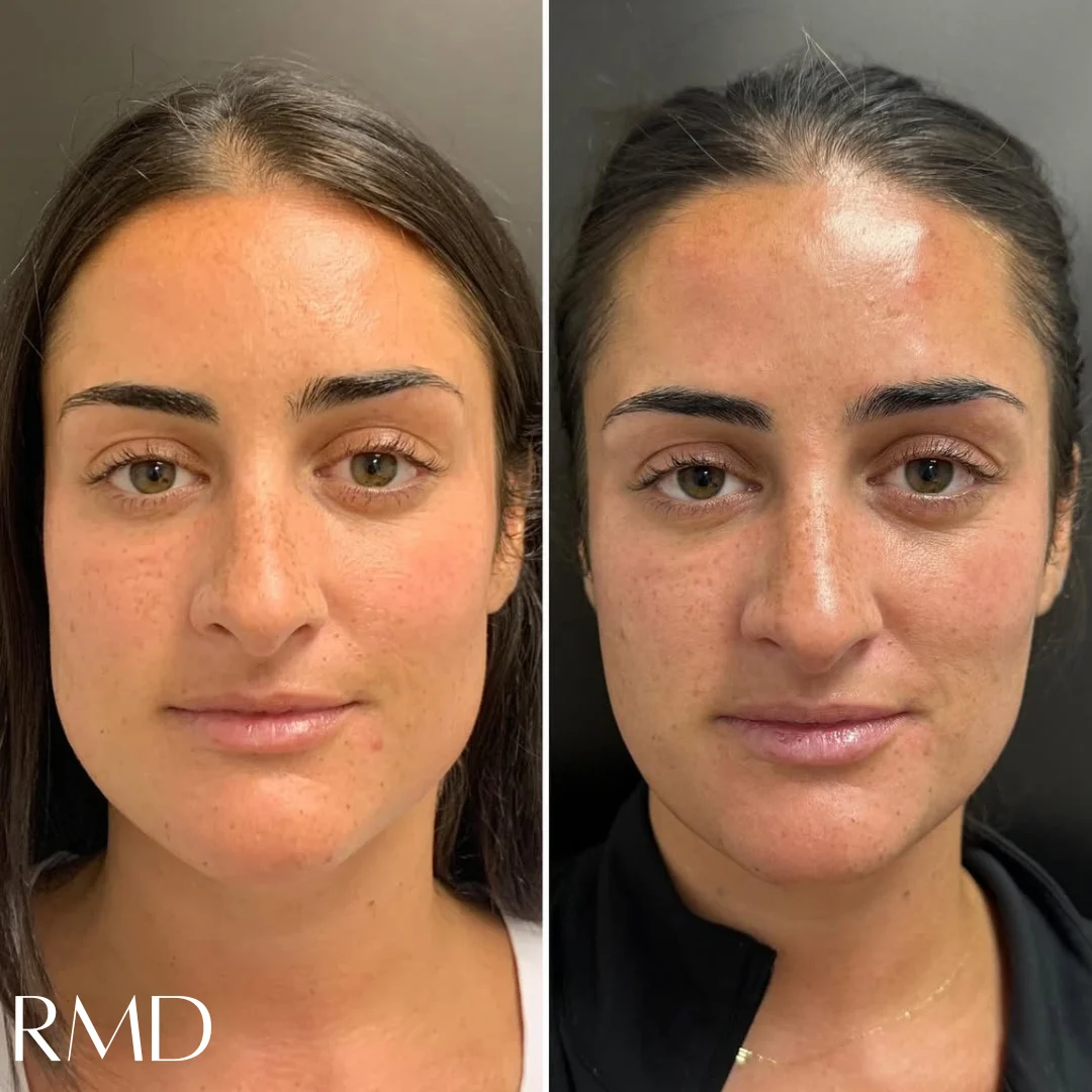 A comparison of a woman's face comparing her skin and after in Northborough, MA