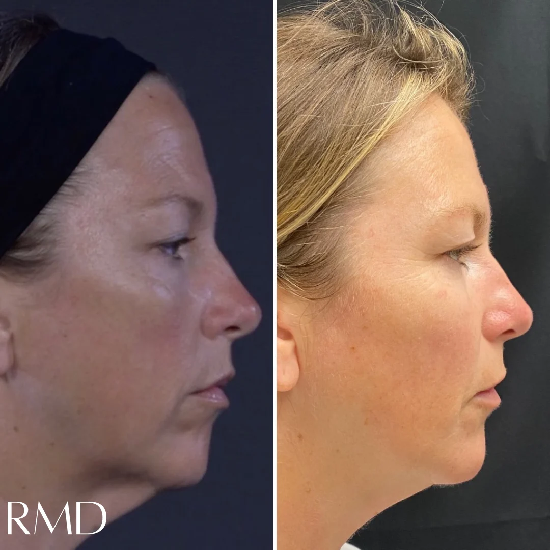 a woman's face with a comparison of the same eyelid in Northborough, MA