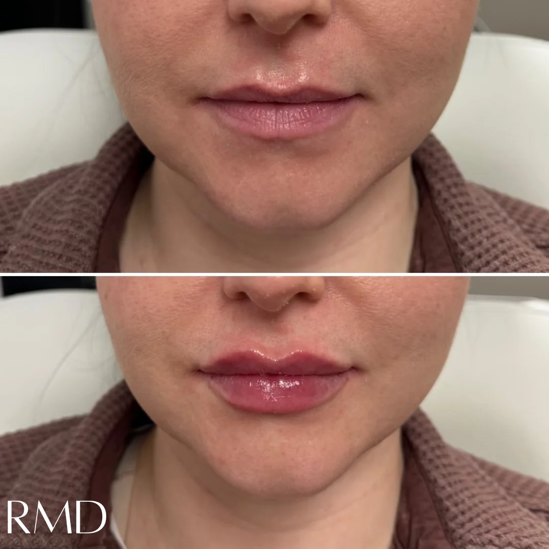 a woman's face with a comparison of her lips after dermal filler in Northborough, MA