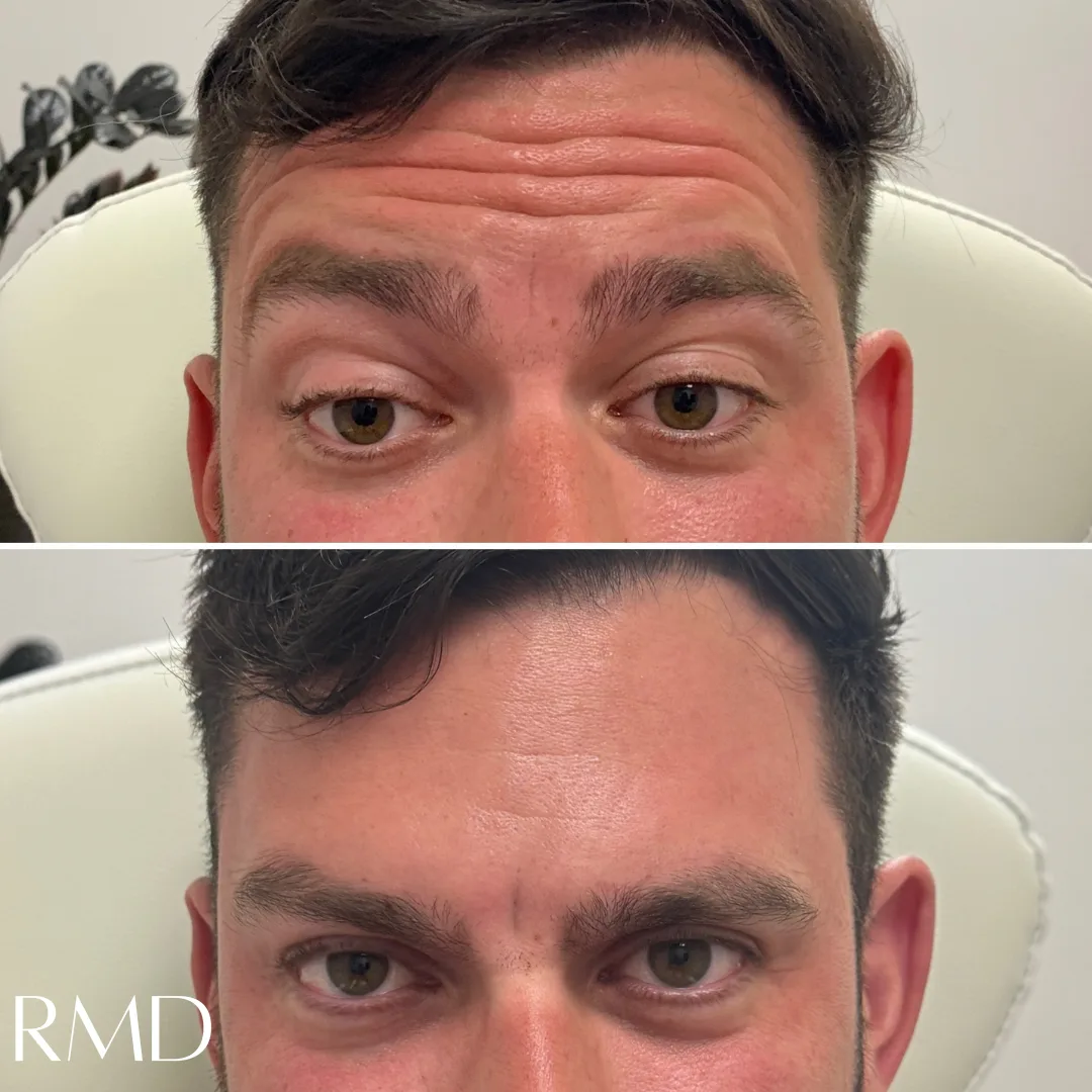 A comparison of a woman's face comparing his skin and after in Northborough, MA