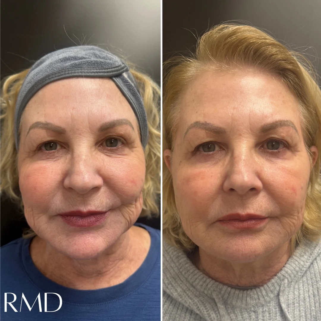 a woman's face with a comparison of the same eyelid in Northborough, MA