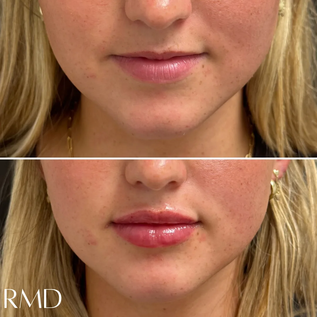 a woman's face with a comparison of her lips after dermal filler in Northborough, MA