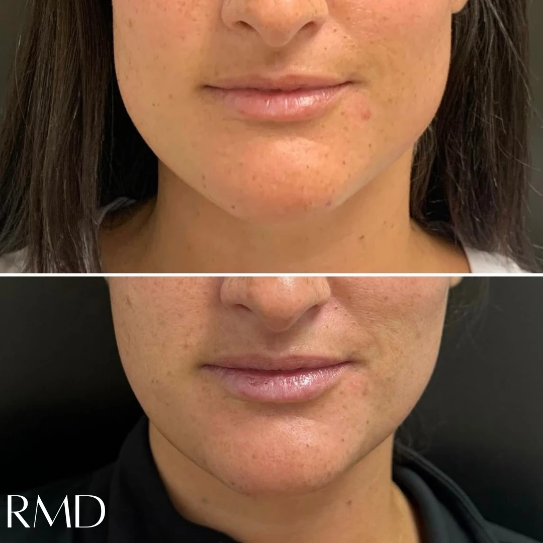 A comparison of a woman's face comparing her skin and after in Northborough, MA