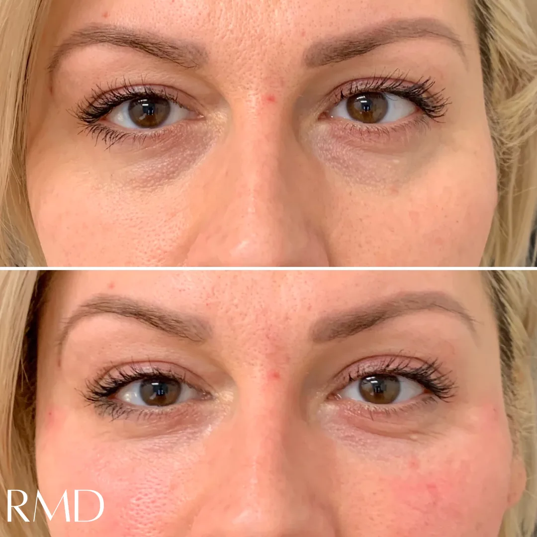 a woman's face with a comparison of the same eyelid in Northborough, MA